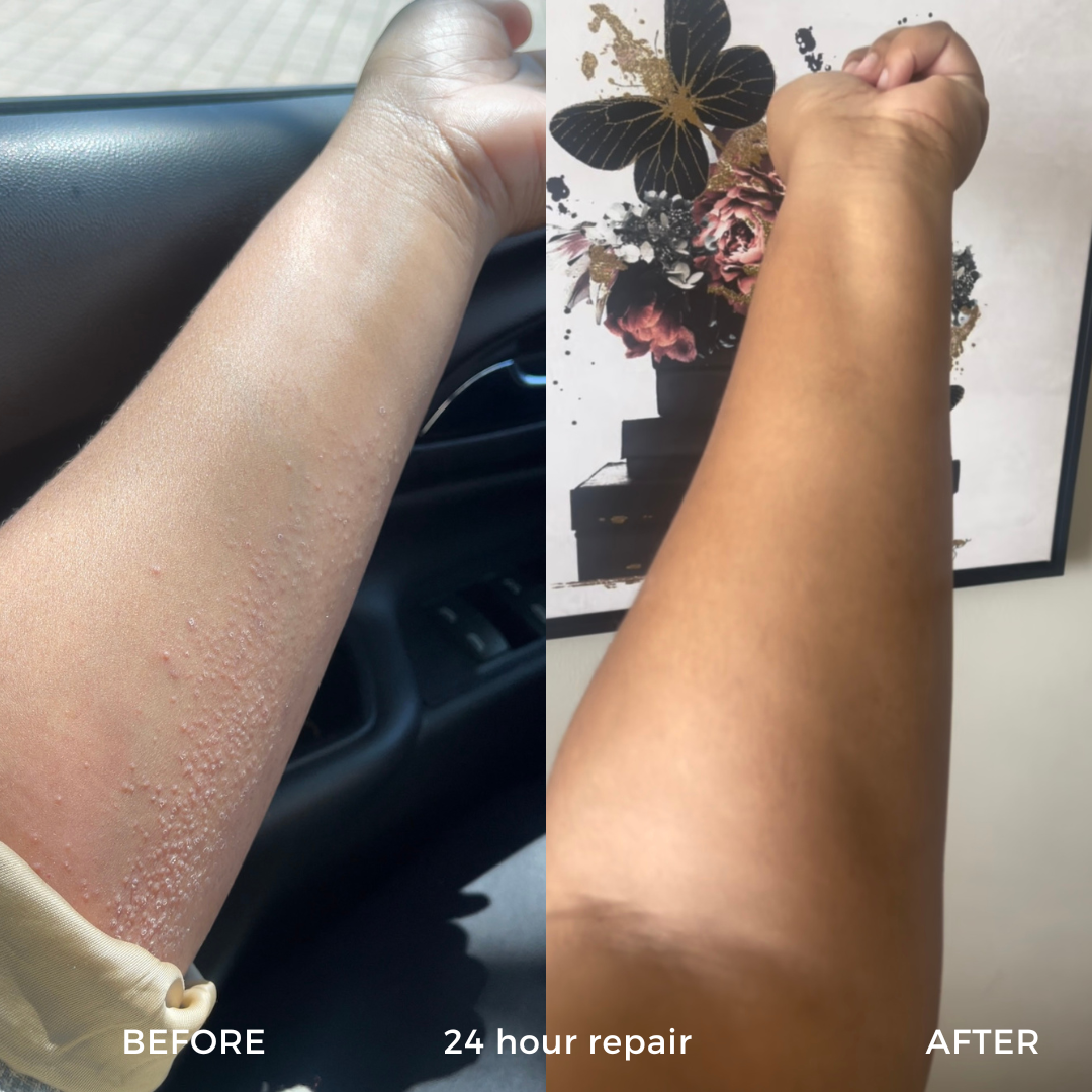 Anti Flare Up Spritz - 55ML | Steroid-Free Made From Plants - As Seen On Vogue